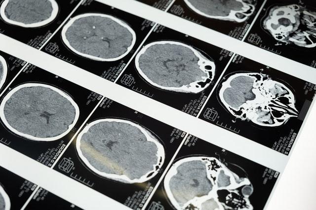 Brain scans mapped over different sections