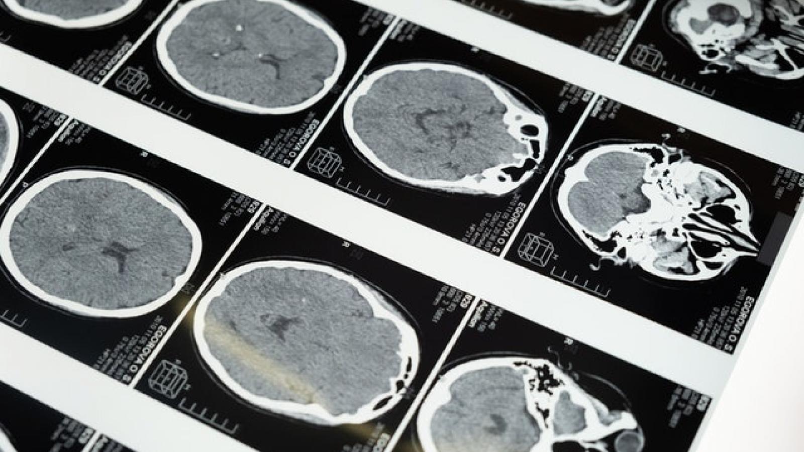 Brain scans mapped over different sections